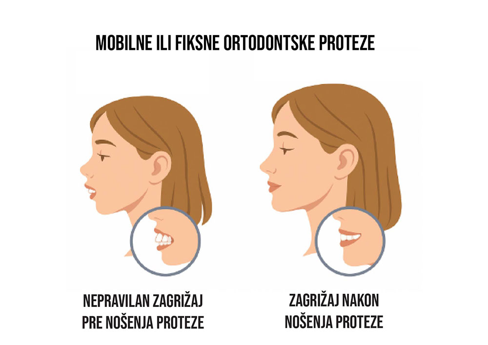 Ilustracija nepravilnog zagrižaja pre i nakon nošenja proteze