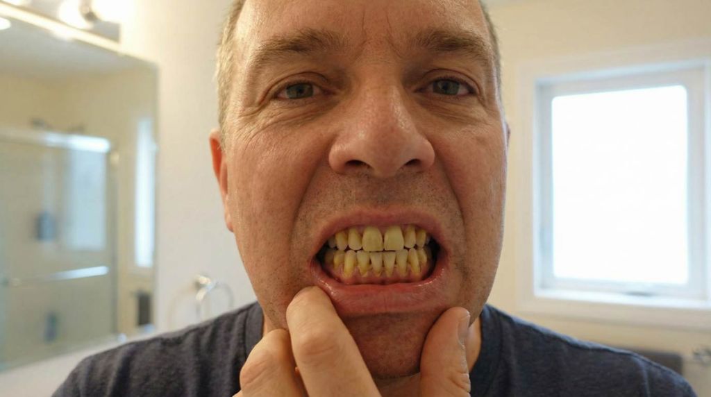 Muškaraca pokazuje zube prepune kamenca